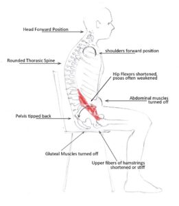 https://spinalcare.com/wp-content/uploads/2018/07/UpperLower-Cross-Syndrome-Pic-261x300.jpg